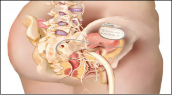 Sacral Nerve Stimulation (InterStim)